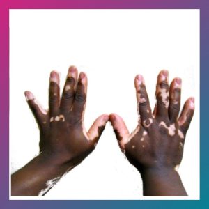 Reverse Vitiligo